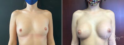 Breast Augmentation Before & After Gallery - Patient 267338 - Image 1