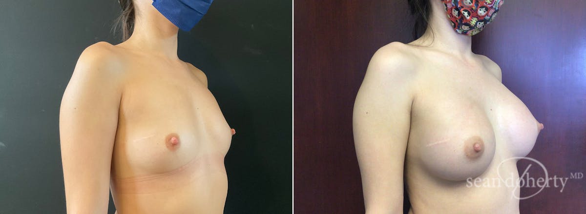Breast Augmentation  Before & After Gallery - Patient 267338 - Image 2