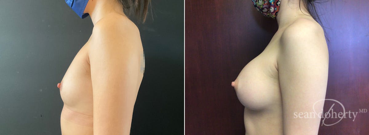 Breast Augmentation  Before & After Gallery - Patient 267338 - Image 3