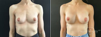 Breast Augmentation Before & After Gallery - Patient 310141 - Image 1