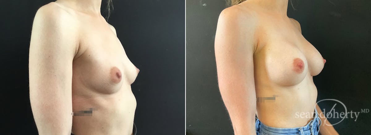 Breast Augmentation Before & After Gallery - Patient 310141 - Image 2