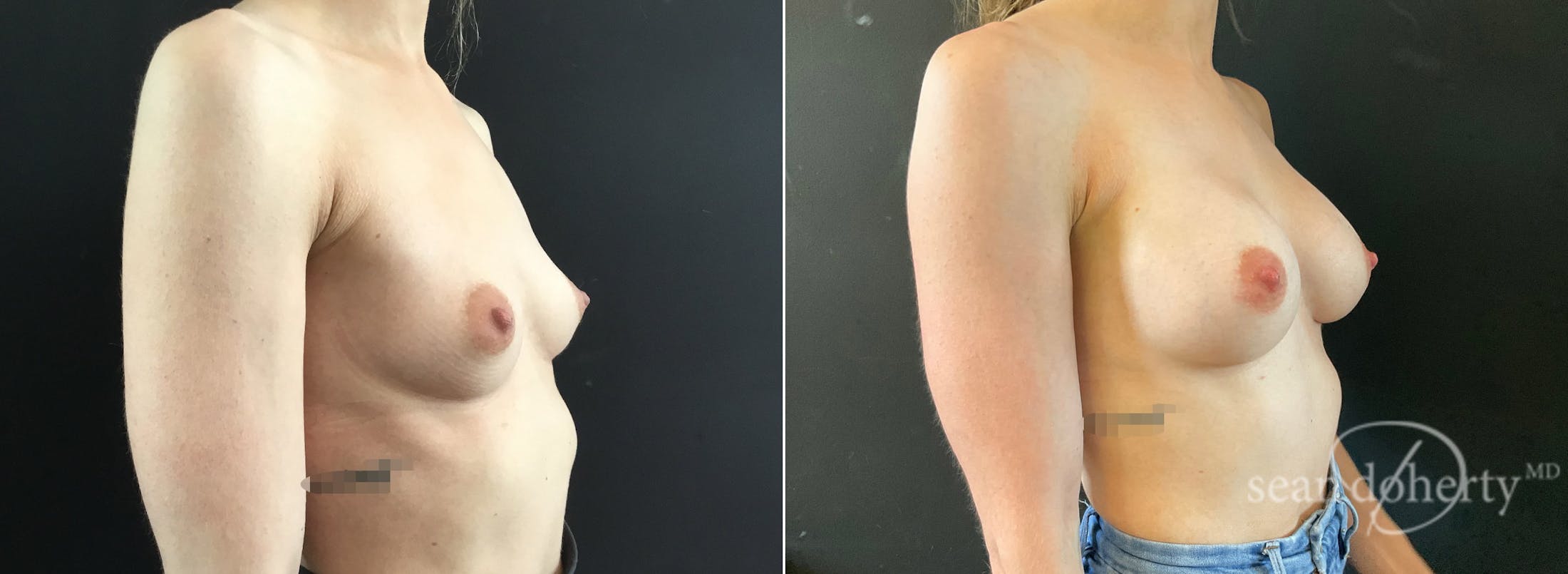 Breast Augmentation Before & After Gallery - Patient 310141 - Image 2