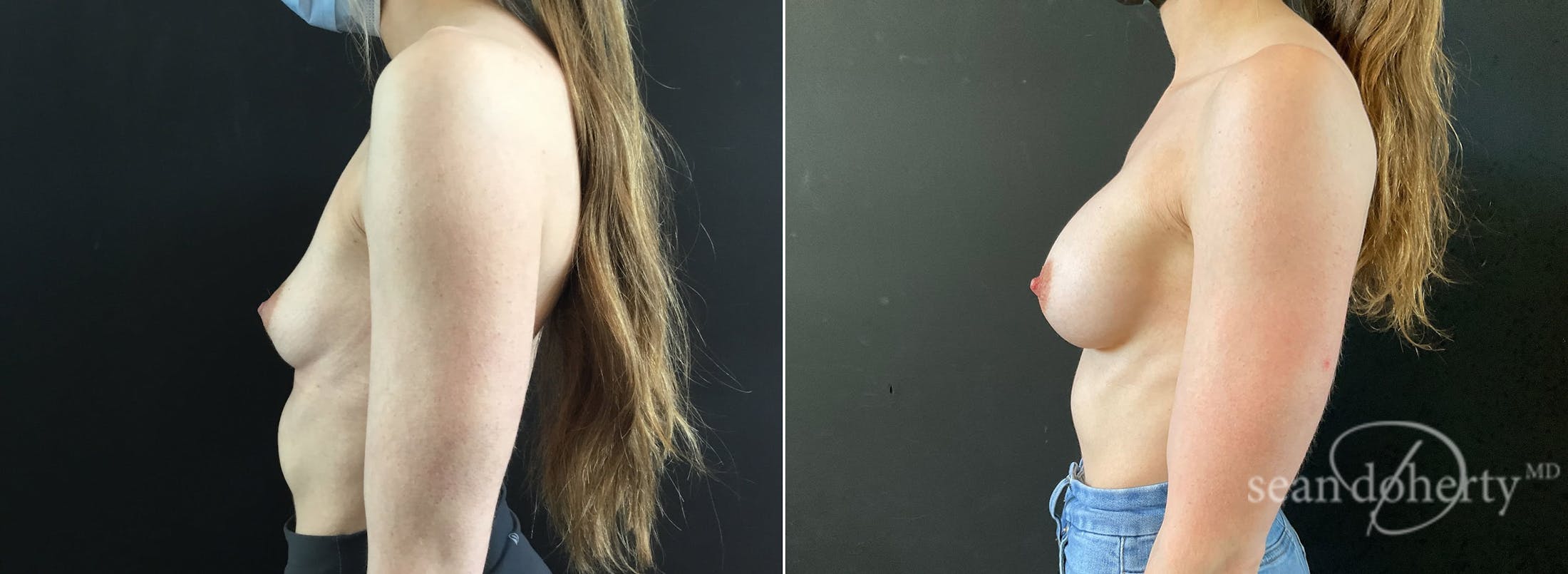 Breast Augmentation Before & After Gallery - Patient 310141 - Image 3