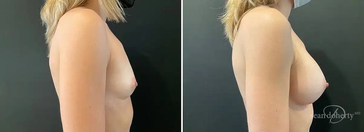 Breast Augmentation  Before & After Gallery - Patient 412499 - Image 3