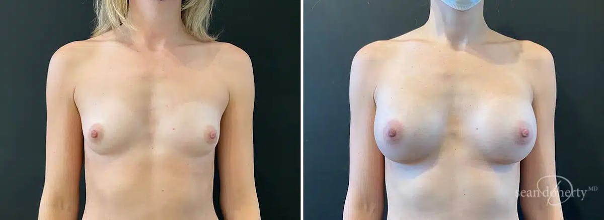 Breast Augmentation  Before & After Gallery - Patient 412499 - Image 1