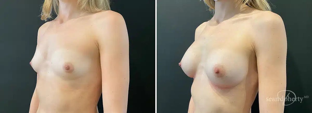 Breast Augmentation  Before & After Gallery - Patient 412499 - Image 2