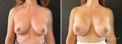 Breast Augmentation Before & After Gallery - Patient 191878 - Image 1