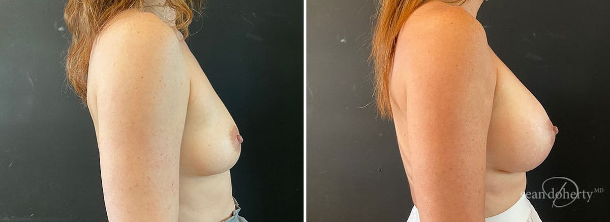 Breast Augmentation  Before & After Gallery - Patient 191878 - Image 3