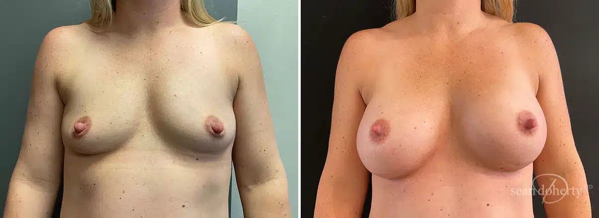 Breast Augmentation Before & After Gallery - Patient 217316 - Image 1