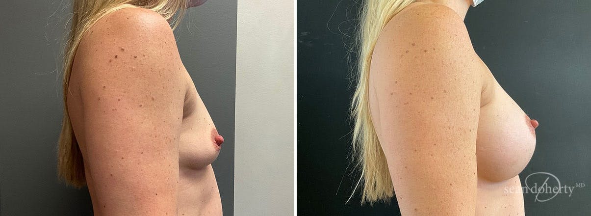 Breast Augmentation Before & After Gallery - Patient 217316 - Image 3