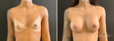 Breast Augmentation Before & After Gallery - Patient 309272 - Image 1