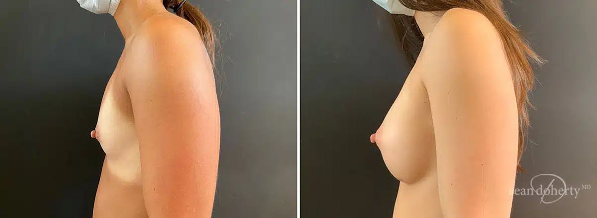 Breast Augmentation Before & After Gallery - Patient 309272 - Image 3