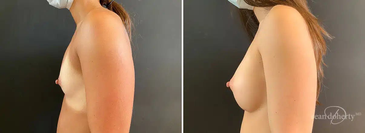 Breast Augmentation Before & After Gallery - Patient 309272 - Image 3