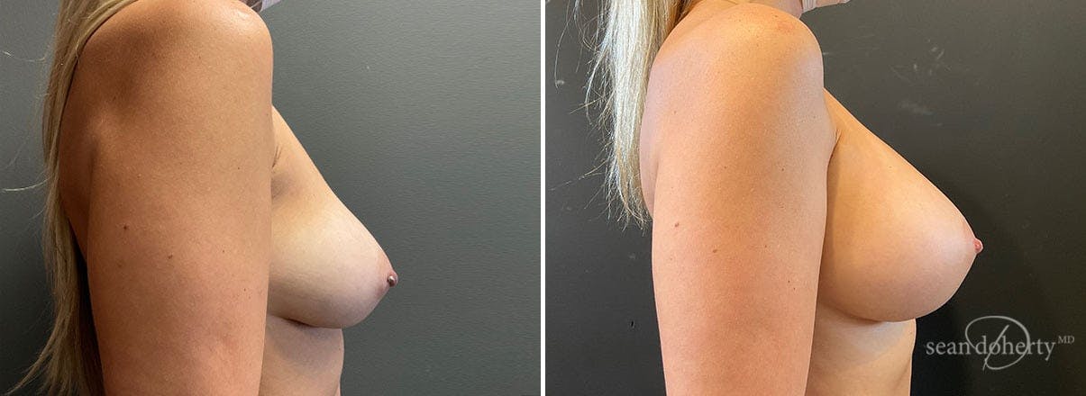 Breast Augmentation Before & After Gallery - Patient 526685 - Image 3