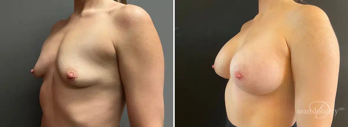 Breast Augmentation Before & After Gallery - Patient 379155 - Image 2