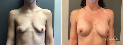 Breast Augmentation Before & After Gallery - Patient 702419 - Image 1
