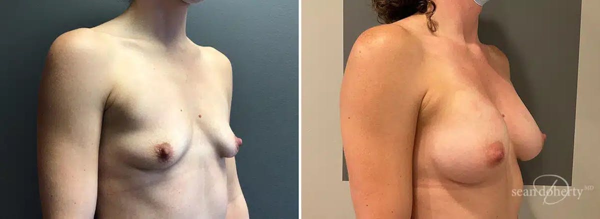 Breast Augmentation Before & After Gallery - Patient 702419 - Image 2