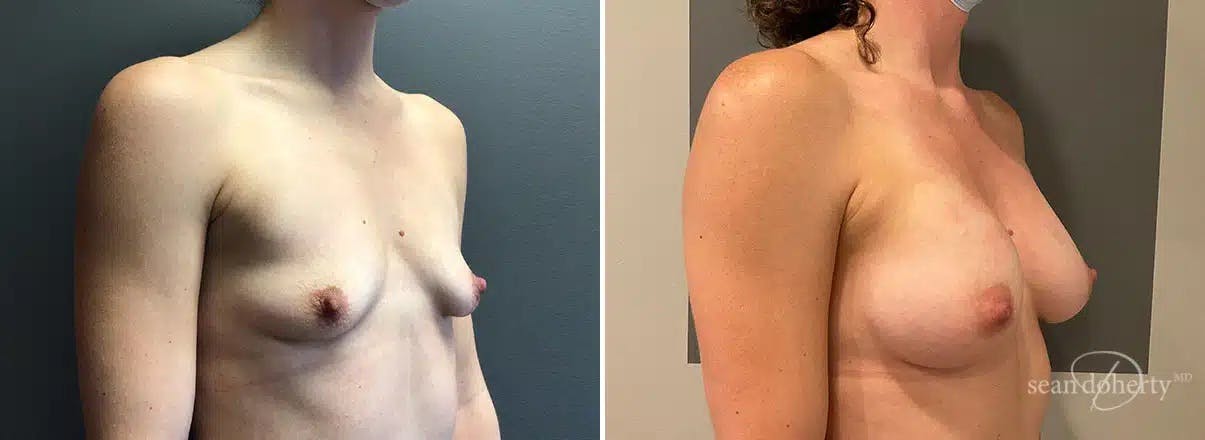 Breast Augmentation Before & After Gallery - Patient 702419 - Image 2