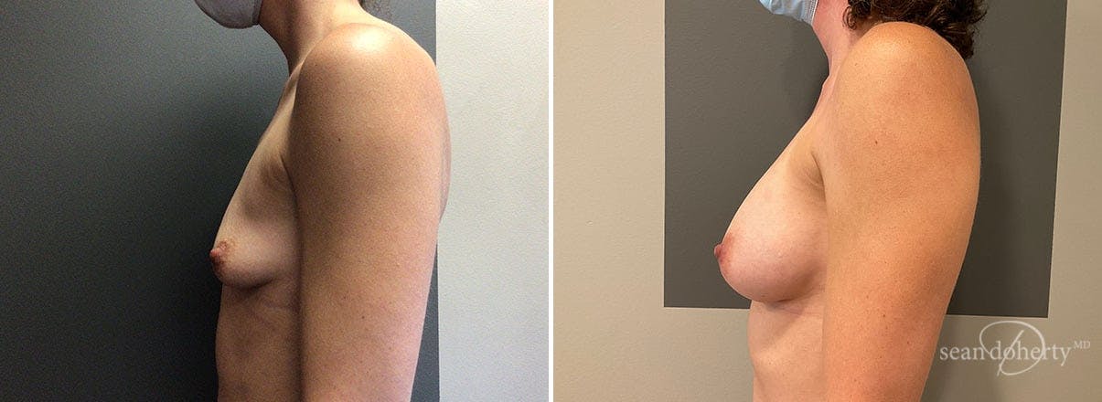Breast Augmentation Before & After Gallery - Patient 702419 - Image 3