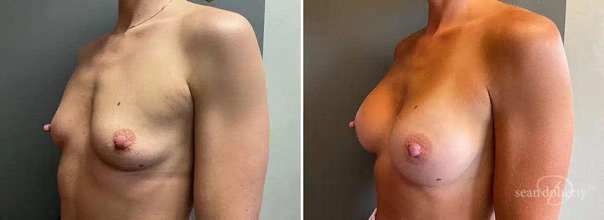 Breast Augmentation Before & After Gallery - Patient 962515 - Image 2