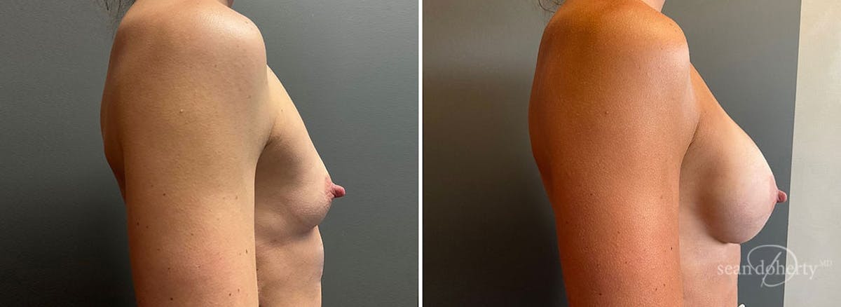 Breast Augmentation Before & After Gallery - Patient 962515 - Image 3