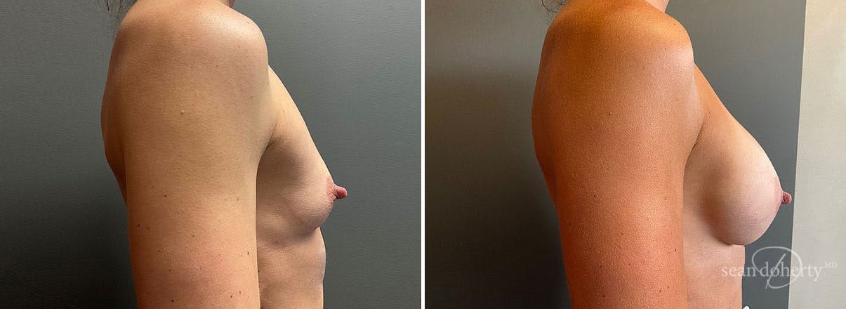 Breast Augmentation Before & After Gallery - Patient 962515 - Image 3
