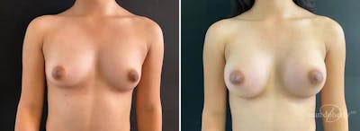 Breast Augmentation Before & After Gallery - Patient 428365 - Image 1