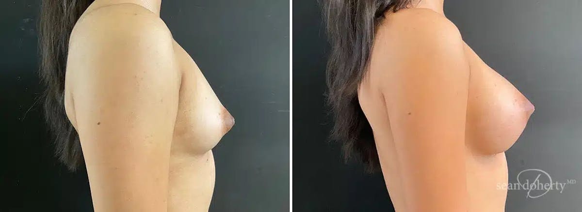 Breast Augmentation  Before & After Gallery - Patient 428365 - Image 3