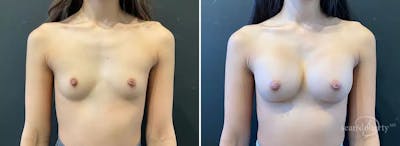 Breast Augmentation Before & After Gallery - Patient 131668 - Image 1