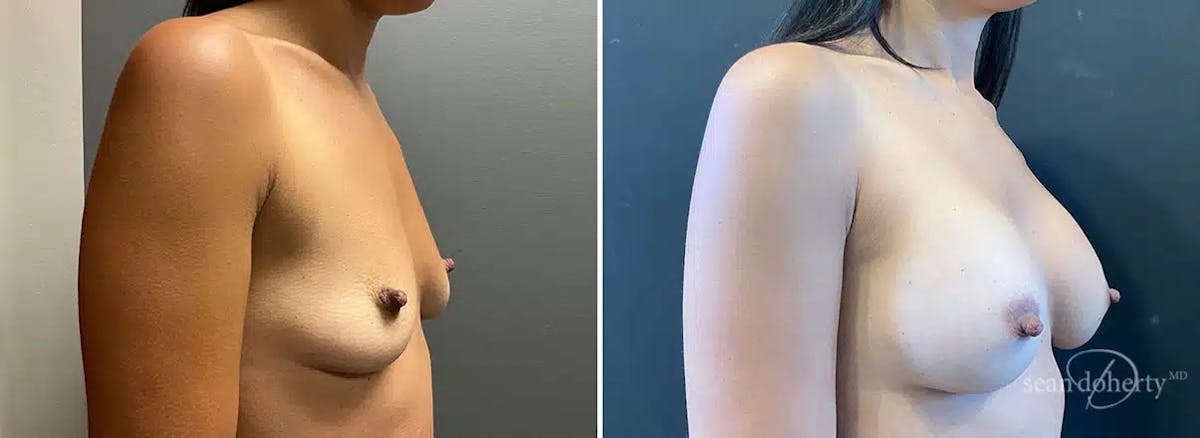 Breast Augmentation  Before & After Gallery - Patient 426274 - Image 2