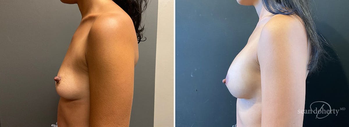 Breast Augmentation  Before & After Gallery - Patient 426274 - Image 3
