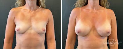 Breast Augmentation Before & After Gallery - Patient 876964 - Image 1