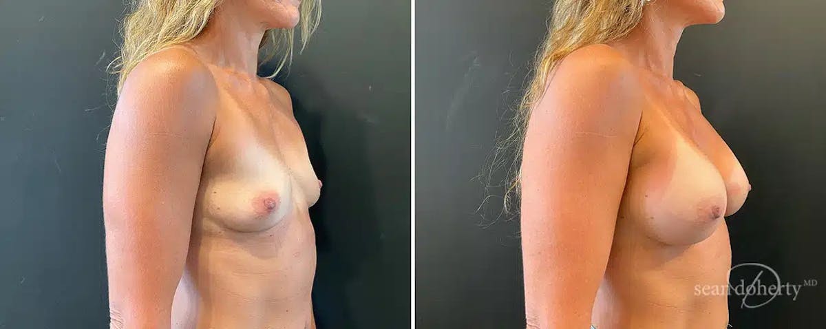 Breast Augmentation  Before & After Gallery - Patient 876964 - Image 2