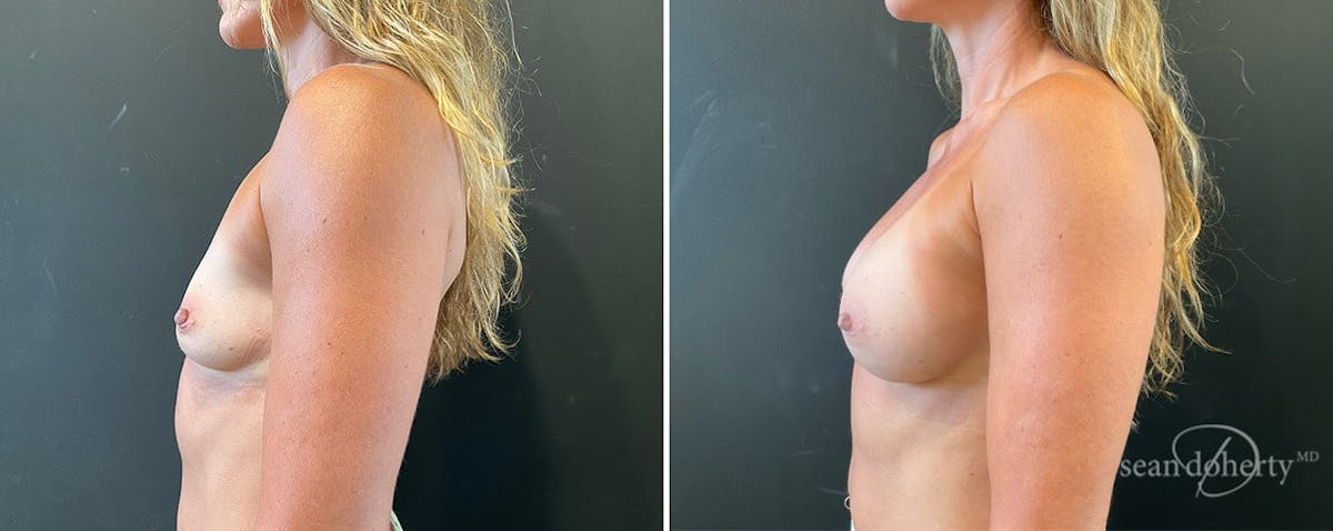 Breast Augmentation  Before & After Gallery - Patient 876964 - Image 3