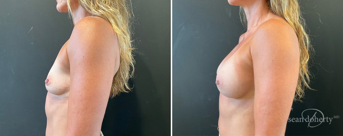 Breast Augmentation Before & After Gallery - Patient 876964 - Image 3