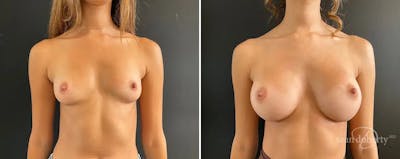 Breast Augmentation Before & After Gallery - Patient 107868 - Image 1