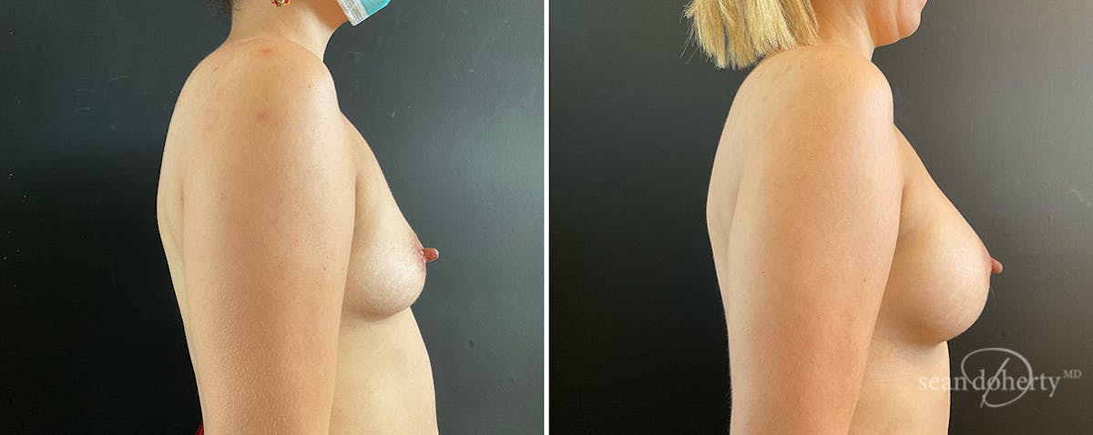 Breast Augmentation  Before & After Gallery - Patient 116368 - Image 3