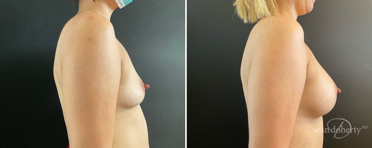 Breast Augmentation Before & After Gallery - Patient 116368 - Image 3