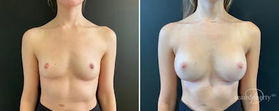Breast Augmentation Before & After Gallery - Patient 107594 - Image 1