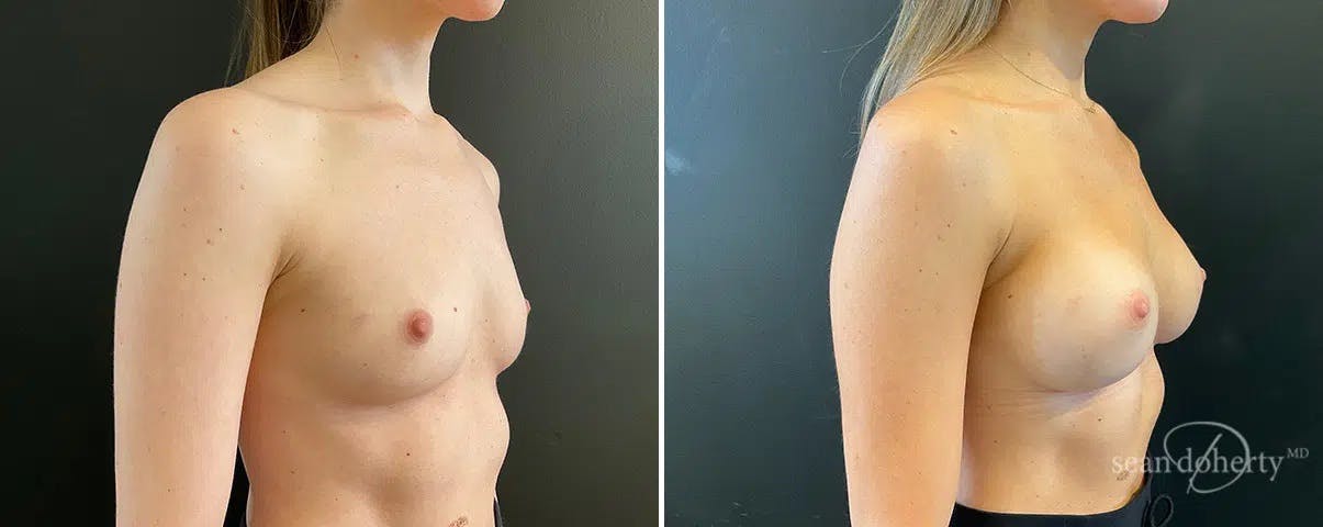 Breast Augmentation Before & After Gallery - Patient 107594 - Image 2