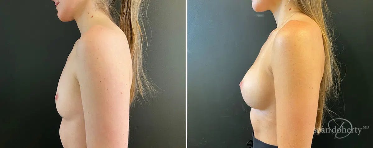 Breast Augmentation  Before & After Gallery - Patient 107594 - Image 3