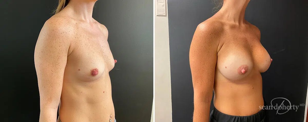 Breast Augmentation  Before & After Gallery - Patient 322681 - Image 2