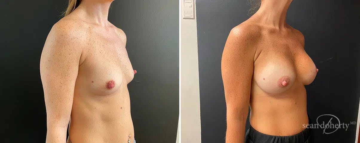 Breast Augmentation Before & After Gallery - Patient 322681 - Image 2
