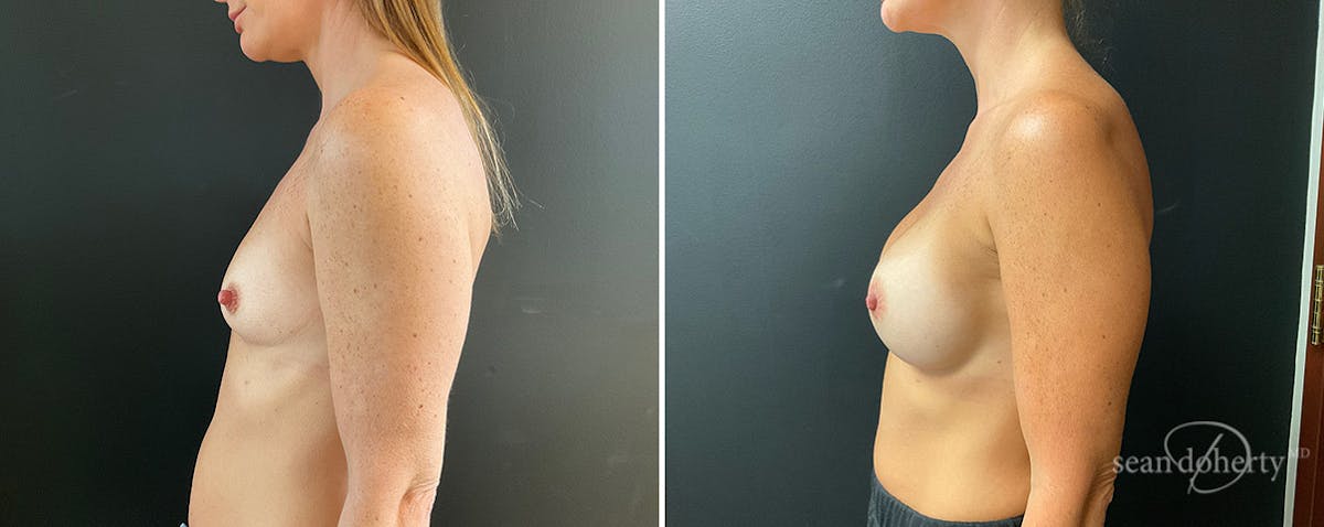 Breast Augmentation  Before & After Gallery - Patient 322681 - Image 3