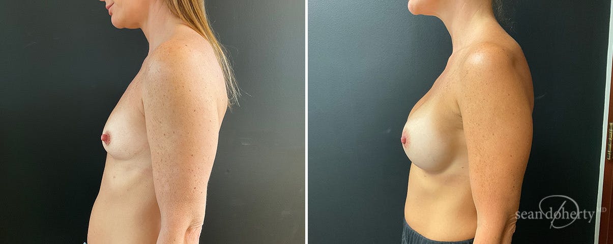 Breast Augmentation Before & After Gallery - Patient 322681 - Image 3