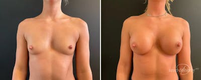 Breast Augmentation Before & After Gallery - Patient 198683 - Image 1