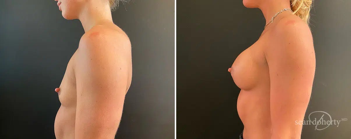 Breast Augmentation Before & After Gallery - Patient 198683 - Image 3