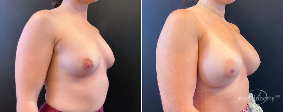 Breast Augmentation Before & After Gallery - Patient 408464 - Image 2