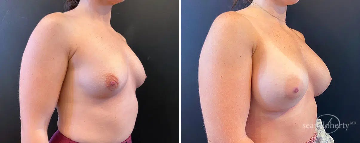 Breast Augmentation Before & After Gallery - Patient 408464 - Image 2