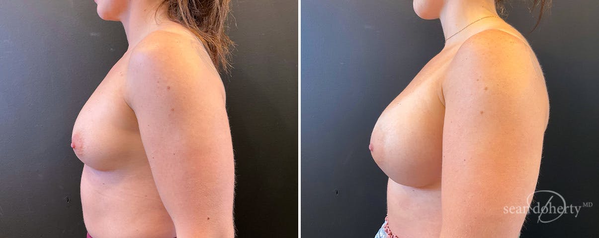 Breast Augmentation Before & After Gallery - Patient 408464 - Image 3